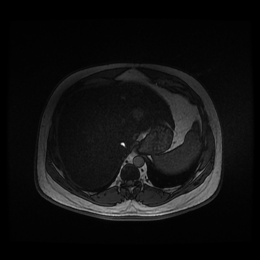 Autosomal dominant polycystic kidney disease (Radiopaedia 50259-55611 Axial 2D Dual Echo 21).jpg