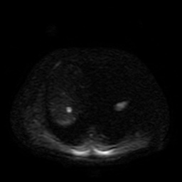 Autosomal dominant polycystic kidney disease (Radiopaedia 50259-55611 Axial DWI 40).jpg