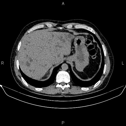 Autosomal dominant polycystic kidney disease (Radiopaedia 87830-104287 Axial non-contrast 11).jpg