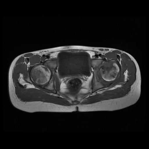 File:Avascular necrosis of the hip (Radiopaedia 29563-30067 Axial T1 7).jpg