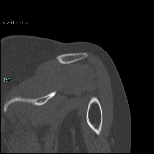 Avascular necrosis of the shoulder - Cruess stage I (Radiopaedia 77674-89887 Coronal bone window 70).jpg