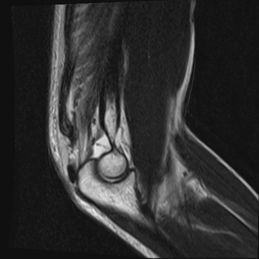 File:Avulsion of the triceps tendon (Radiopaedia 42919-46154 Sagittal T2 5).jpg
