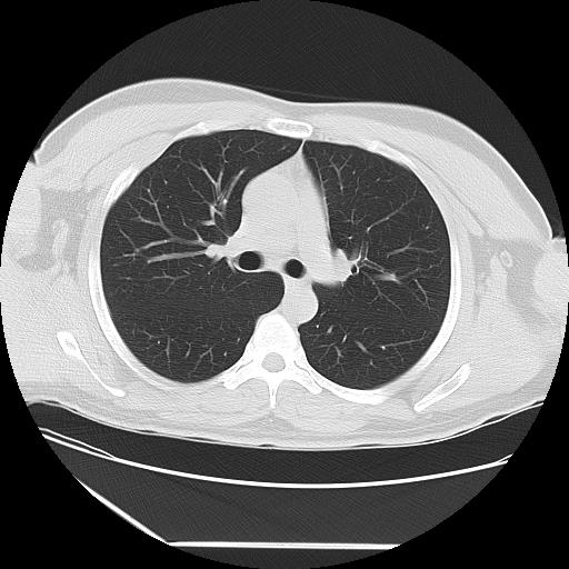 Azygos fissure (Radiopaedia 88181-104784 Axial lung window 19).jpg