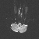 Balo concentric sclerosis (Radiopaedia 50458-55940 Axial DWI 42).jpg