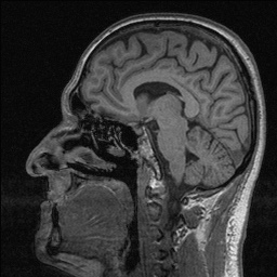 Balo concentric sclerosis (Radiopaedia 50458-55940 Sagittal T1 87).jpg