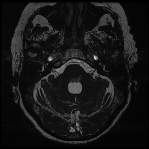 File:Balo concentric sclerosis (Radiopaedia 53875-59982 Axial T2 FIESTA 32).jpg