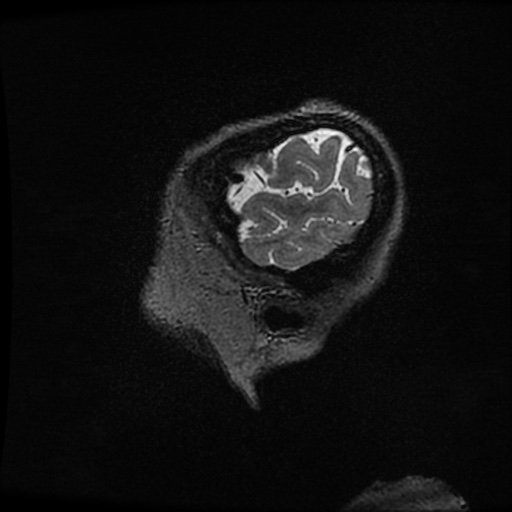 Balo concentric sclerosis (Radiopaedia 53875-59982 Sagittal 3D FSE 17).jpg