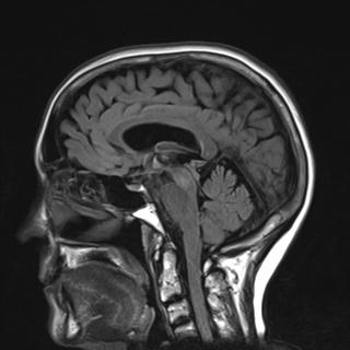 File:Base of skull chondrosarcoma (Radiopaedia 30410-31070 Sagittal FLAIR 12).jpg