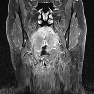 File:Base of tongue squamous cell carcinoma (Radiopaedia 31174-31884 E 9).jpg
