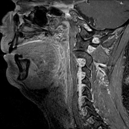 Base of tongue squamous cell carcinoma (Radiopaedia 31174-31884 F 108).jpg