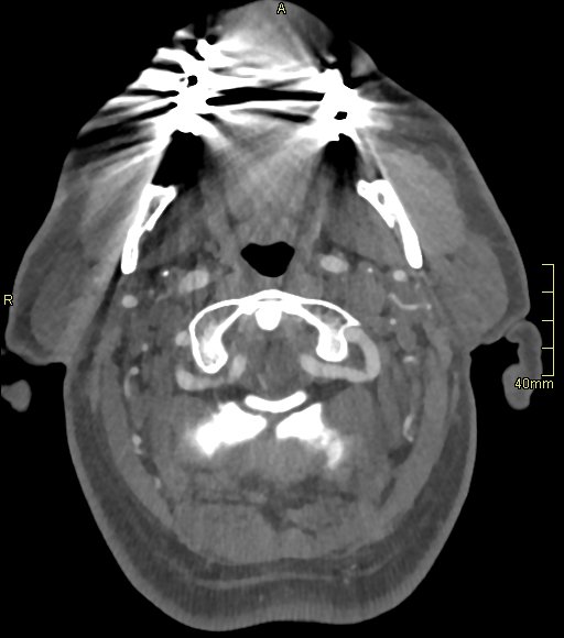 Basilar artery aneurysm (Radiopaedia 56261-62932 A 29).jpg