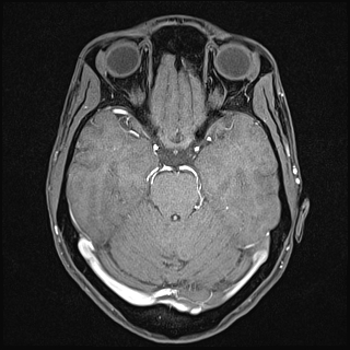 Basilar artery perforator aneurysm (Radiopaedia 82455-97733 Axial T1 fat sat 57).jpg
