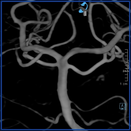 File:Basilar artery perforator aneurysm (Radiopaedia 82455-99524 3D Left VA 40).jpg