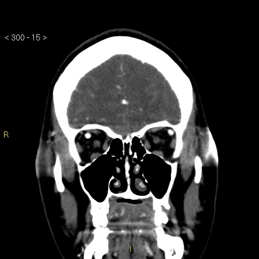 Basilar artery thrombosis (Radiopaedia 16260-15944 B 6).jpg