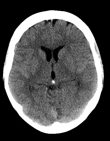File:Basilar tip aneurysm with coiling (Radiopaedia 53912-60033 Axial non-contrast 13).jpg
