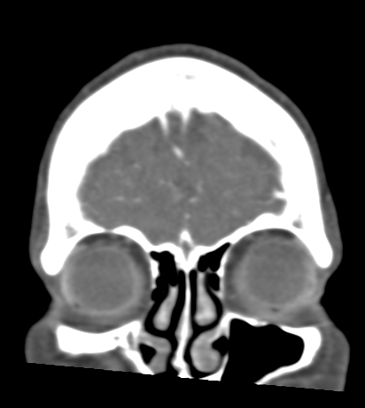 Basilar tip aneurysm with coiling (Radiopaedia 53912-60086 B 12).jpg