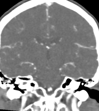 Basilar tip aneurysm with coiling (Radiopaedia 53912-60086 B 85).jpg