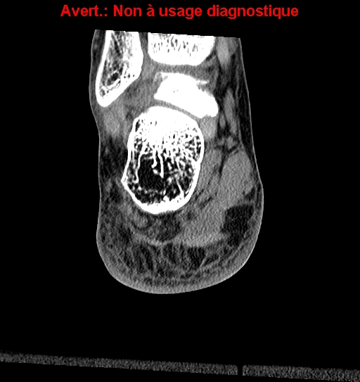 Baxter neuropathy (Radiopaedia 25988-26125 Coronal non-contrast 31).jpg