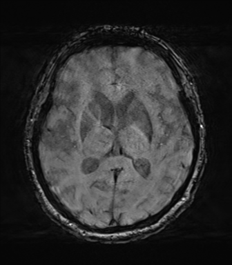 Behavioral variant frontotemporal dementia and late onset schizophrenia (Radiopaedia 52197-58083 Axial SWI 39).png