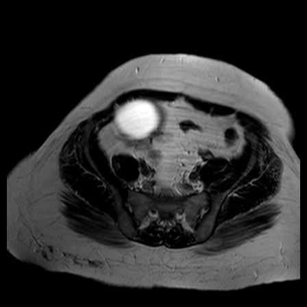 File:Benign seromucinous cystadenoma of the ovary (Radiopaedia 71065-81300 B 13).jpg