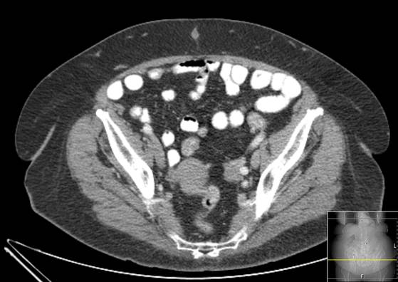Bicameral celiacomesenteric aneurysm (Radiopaedia 55766-62327 A 57).jpg