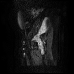 File:Bicornuate uterus (Radiopaedia 51676-57472 Sagittal DWI 25).jpg