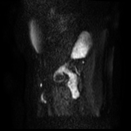 File:Bicornuate uterus (Radiopaedia 51676-57472 Sagittal DWI 49).jpg