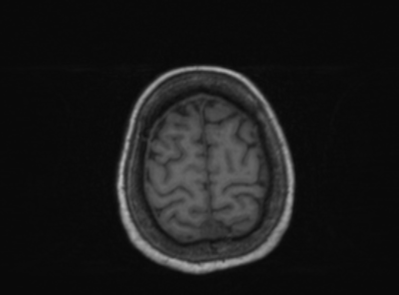 Bilateral PCA territory infarction - different ages (Radiopaedia 46200-51784 Axial T1 143).jpg