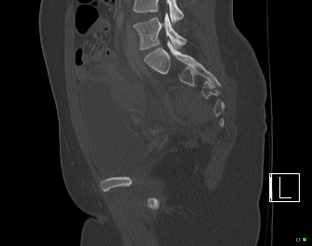 Bilateral acetabular fractures (Radiopaedia 79272-92308 Sagittal bone window 52).jpg