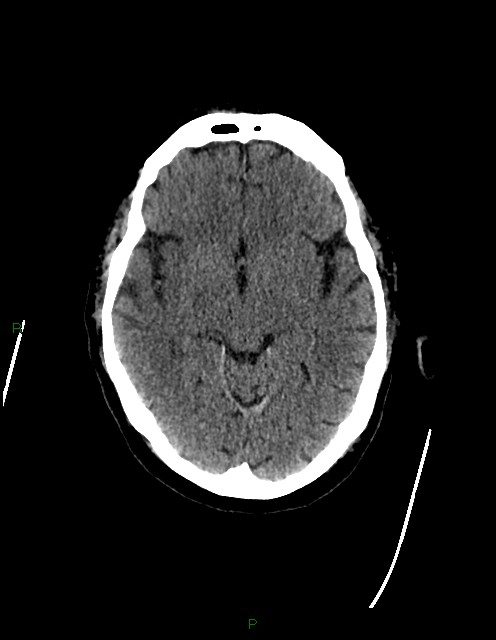 Bilateral acute middle cerebral artery territory infarcts (Radiopaedia 77319-89401 Axial non-contrast 37).jpg