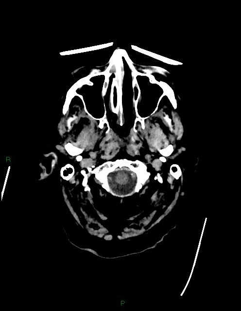 Bilateral acute middle cerebral artery territory infarcts (Radiopaedia 77319-89401 Axial non-contrast 4).jpg