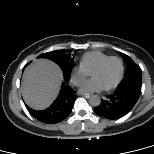Bilateral adrenal gland hyperenhancement in pancreatitis (Radiopaedia 86642-102753 Axial non-contrast 3).jpg
