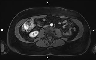 Bilateral adrenal myelolipoma (Radiopaedia 63058-71537 Axial T1 C+ fat sat 65).jpg