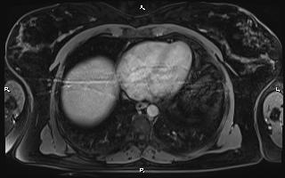 File:Bilateral adrenal myelolipoma (Radiopaedia 63058-71537 H 9).jpg