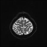 File:Bilateral basal ganglia and thalamic T1 hyperintensities (Radiopaedia 19764-19802 Axial DWI 18).jpg