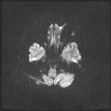 File:Bilateral basal ganglia and thalamic T1 hyperintensities (Radiopaedia 19764-19802 Axial DWI 23).jpg