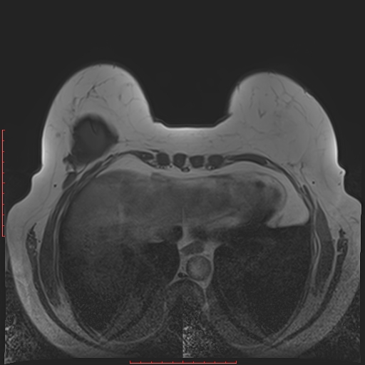 File:Bilateral breast implant rupture (Radiopaedia 24761-25027 T1 30).jpg