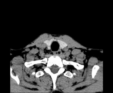 Bilateral carotid body tumors (Radiopaedia 61841-69870 Axial non-contrast 99).jpg