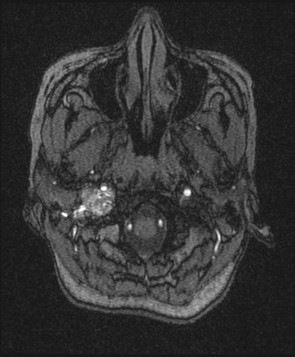 Bilateral carotid body tumors and right glomus jugulare tumor (Radiopaedia 20024-20060 Axial MRA 16).jpg