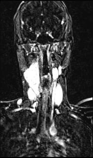 Bilateral carotid body tumors and right glomus jugulare tumor (Radiopaedia 20024-20060 MRA 95).jpg