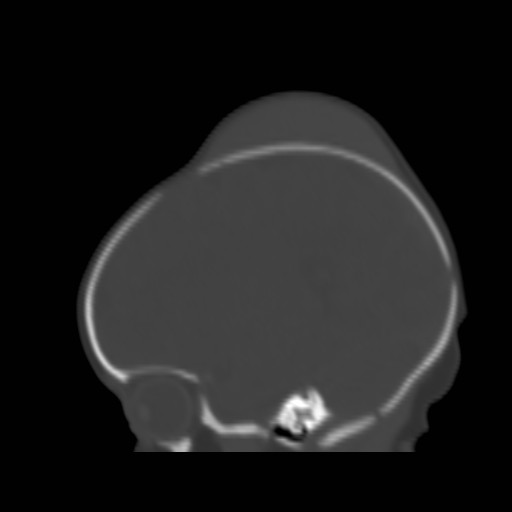 File:Bilateral cephalohematomas and subdural hematomas (Radiopaedia 26778-26929 Sagittal bone window 30).jpg