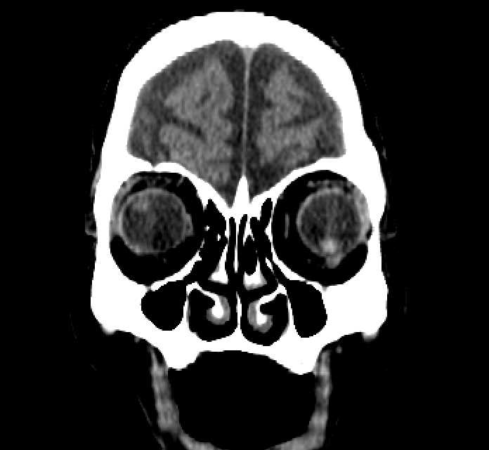 Bilateral ectopia lentis (Radiopaedia 89889-107013 Coronal non-contrast 40).jpg