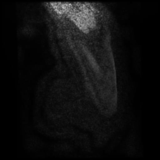 Bilateral elastofibromas dorsi (Radiopaedia 90158-107344 H 1).jpg