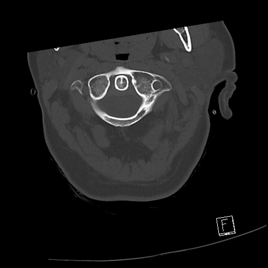 Bilateral occipital condyle fractures (type 3) (Radiopaedia 87672-104086 Axial bone window 17).jpg