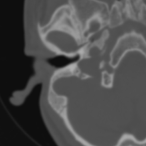 Bilateral otosclerosis (Radiopaedia 57237-64157 B 35).jpg