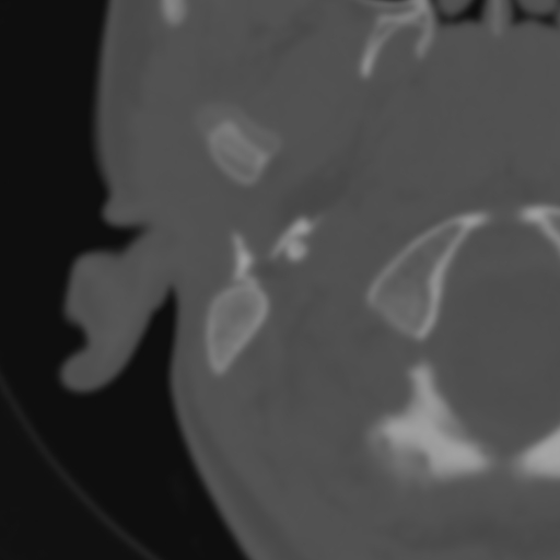 Bilateral otosclerosis (Radiopaedia 57237-64157 B 8).jpg