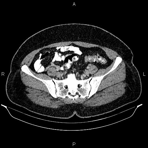Bilateral ovarian dermoid cysts (Radiopaedia 85785-101603 A 82).jpg