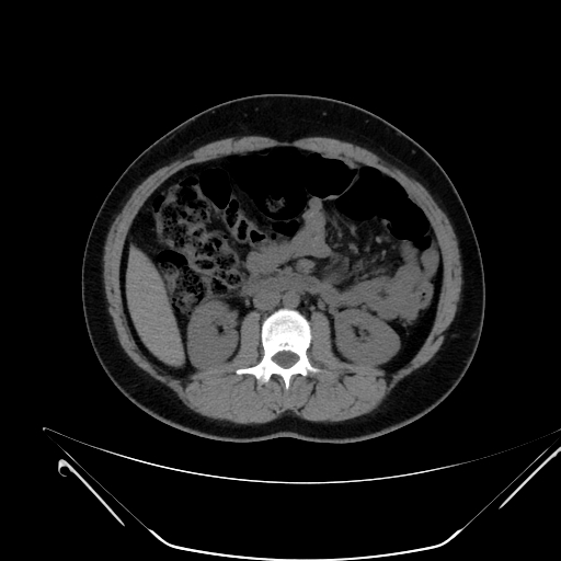 File:Bilateral ovarian mature cystic teratomas (Radiopaedia 79373-92457 Axial non-contrast 26).jpg
