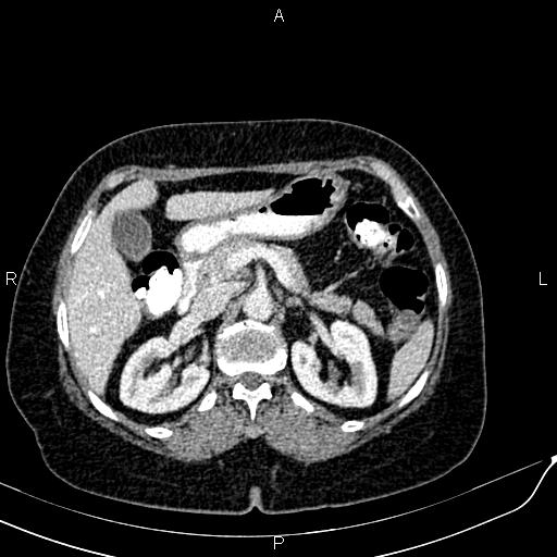 Bilateral ovarian serous cystadenocarcinoma (Radiopaedia 86062-101989 B 33).jpg
