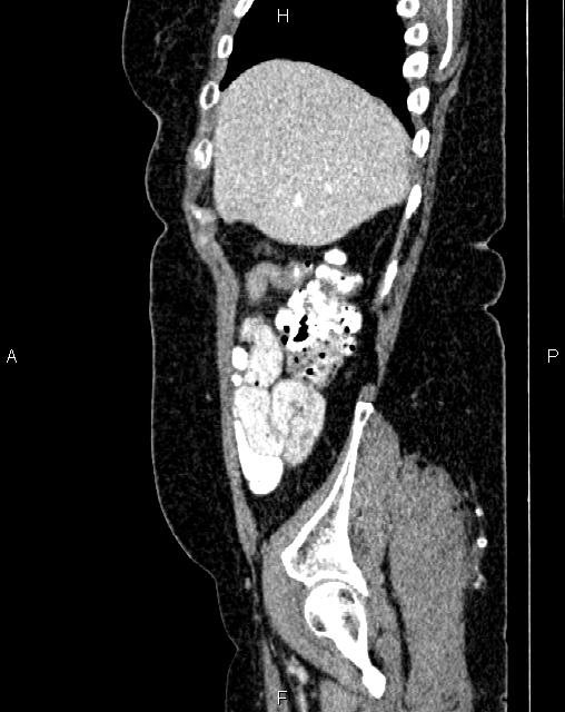 Bilateral ovarian serous cystadenocarcinoma (Radiopaedia 86062-101989 E 11).jpg